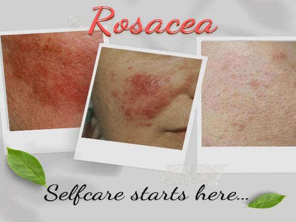Images showing rosacea skin condition with a text overlay: Selfcare starts here - manage rosacea effectively.