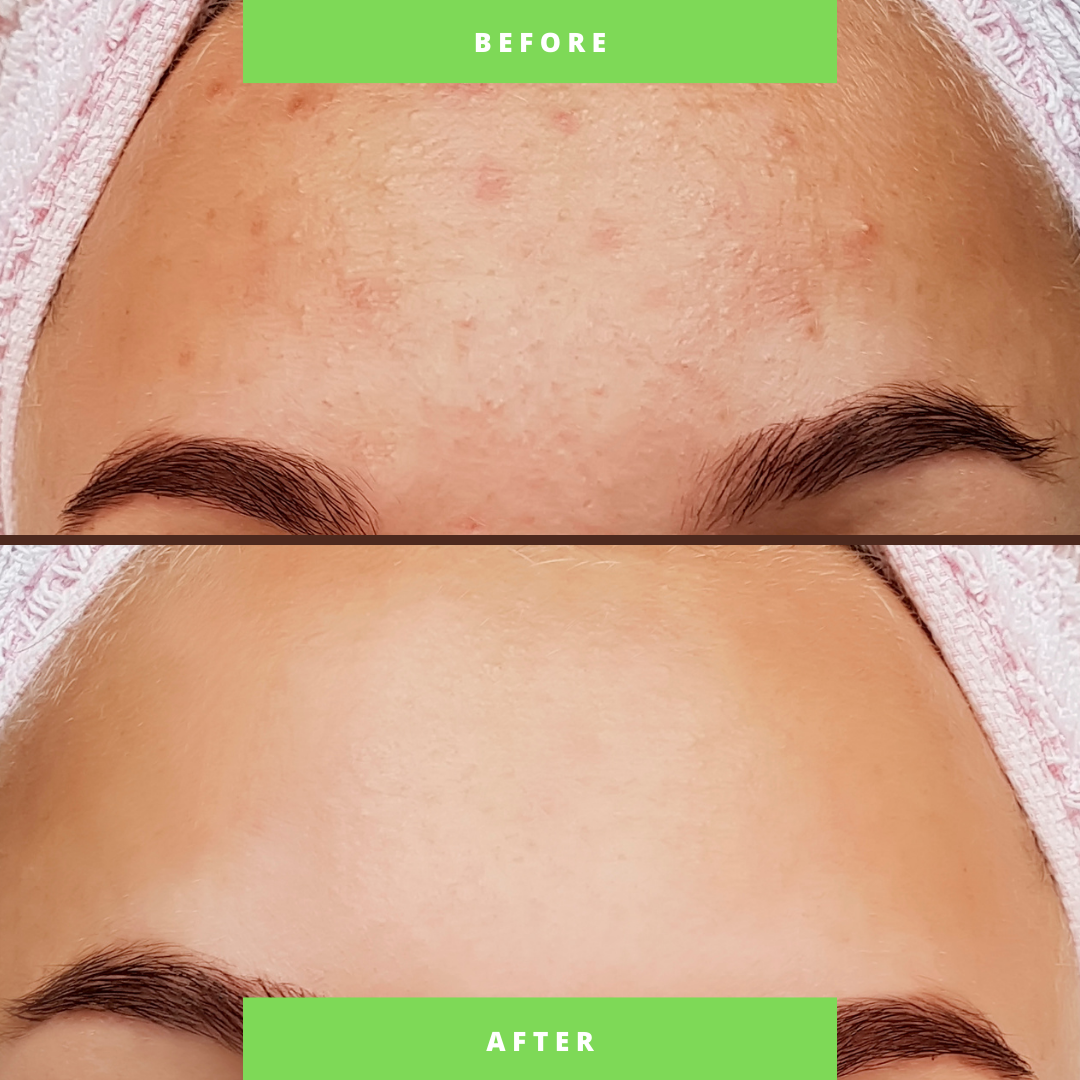 Organic Anti-Acne Nourishing Facial Wash - For WOMEN