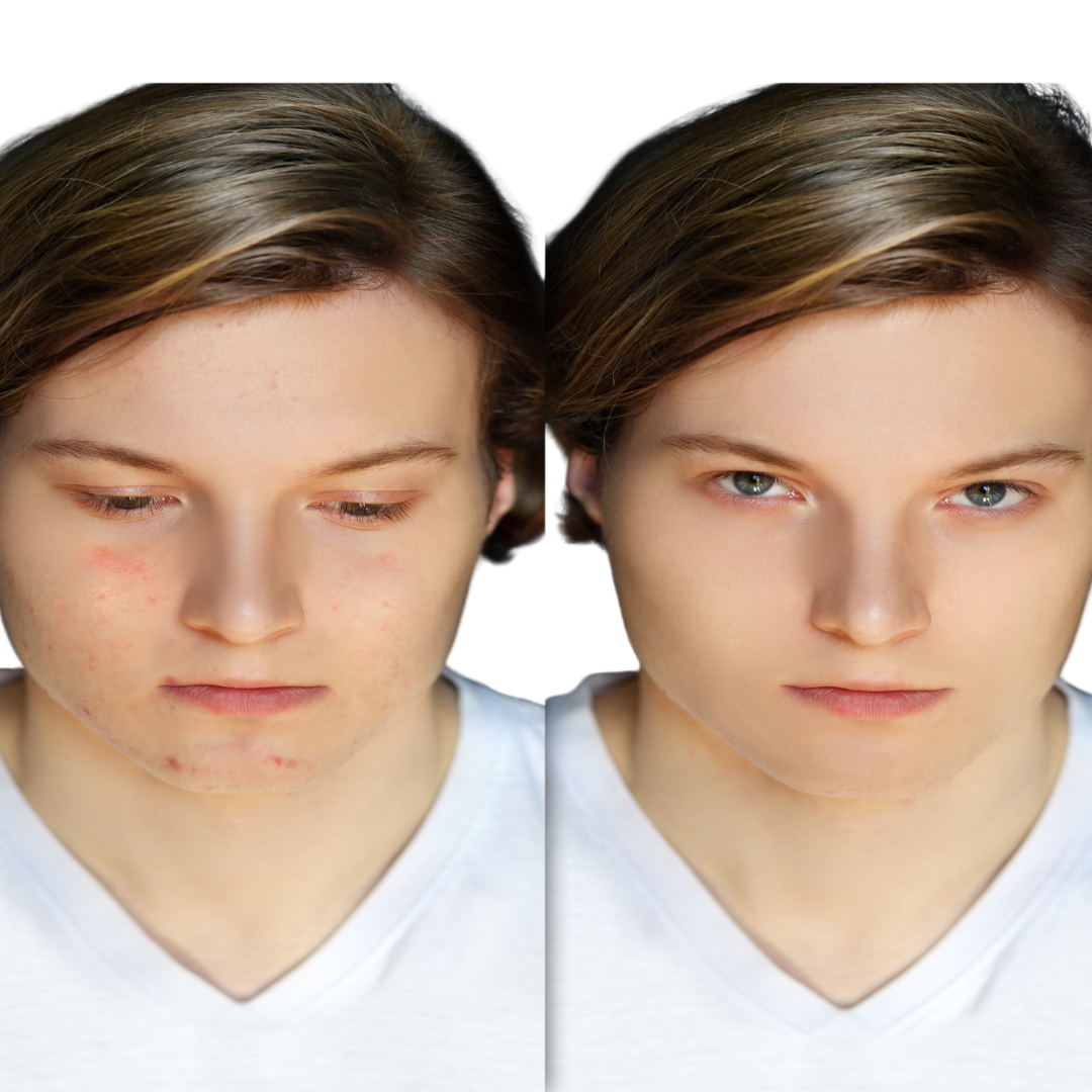 Anti-Acne Organic Two-Step System Facial Scrub and Moisturizer - For MEN