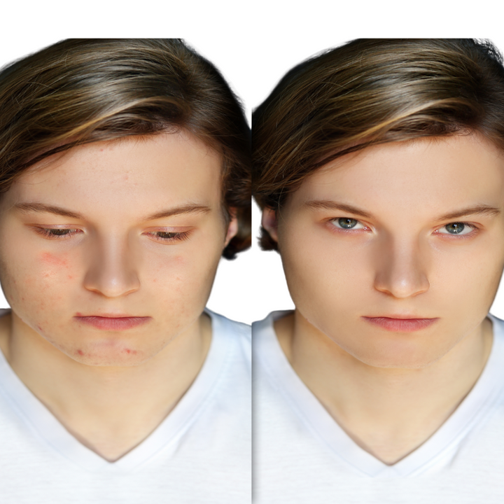 Anti-Acne Organic Two-Step System Facial Scrub and Moisturizer - For MEN